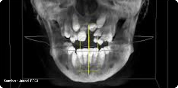 Pemeriksaan Dental Rontgen CBCT Terlengkap di BSD