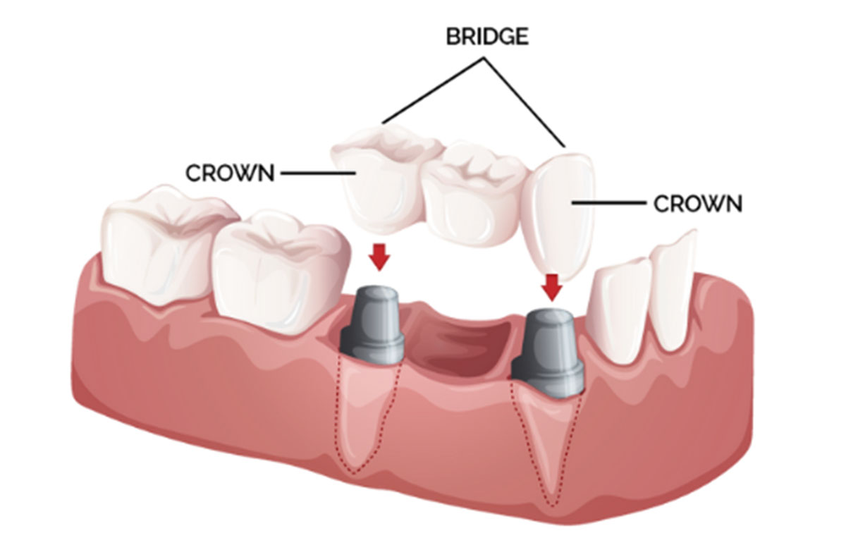 Rekomendasi Layanan Veneer, Crown dan Bridge Terlengkap di BSD