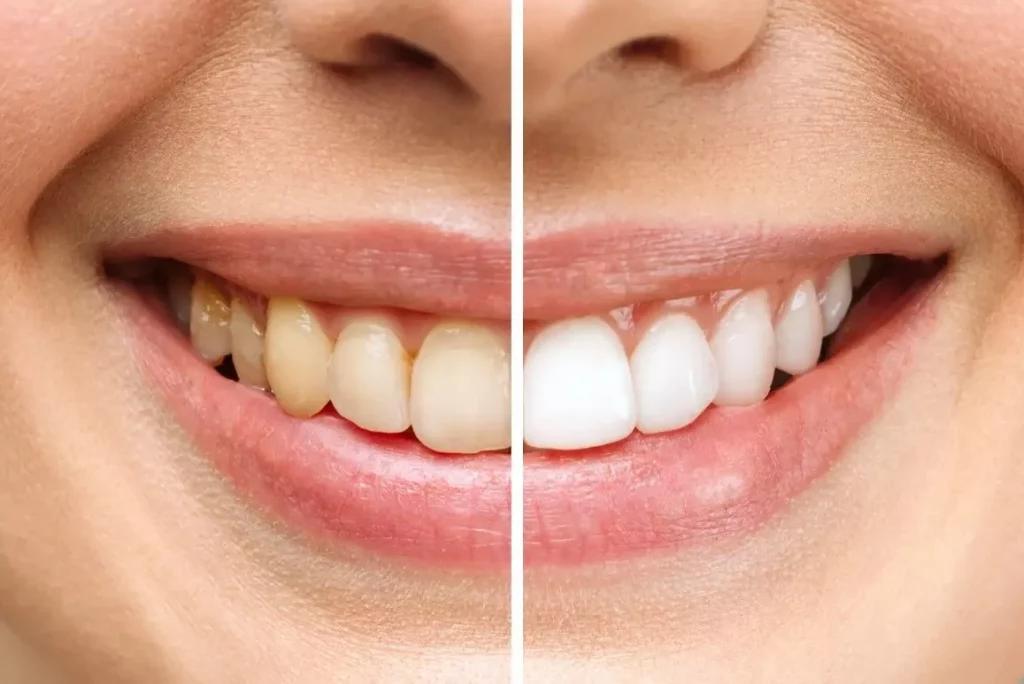 Veneer Gigi di Klinik Gigi BSD: Solusi Estetik untuk Senyum Lebih Percaya Diri? 1 veneer gigi bsd, veneer direct dan indirect, klinik gigi bsd, dokter gigi estetik, veneer gigi tangerang selatan