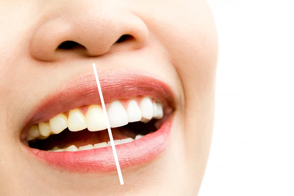 whitening gigi di rumah aman nggak sih ini penjelasan klinik gigi bsd