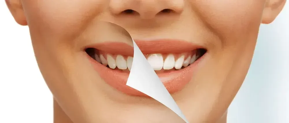 biaya bleaching gigi bsd 1