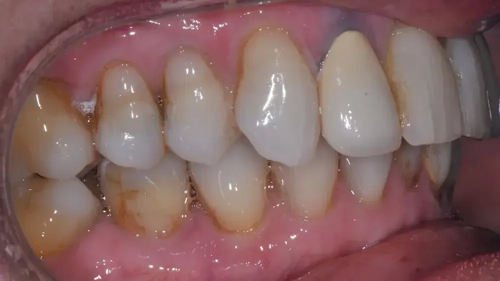 6 Cara Membersihkan Karang Gigi Dengan Bahan Alami 4 cara membersihkan karang gigi 1