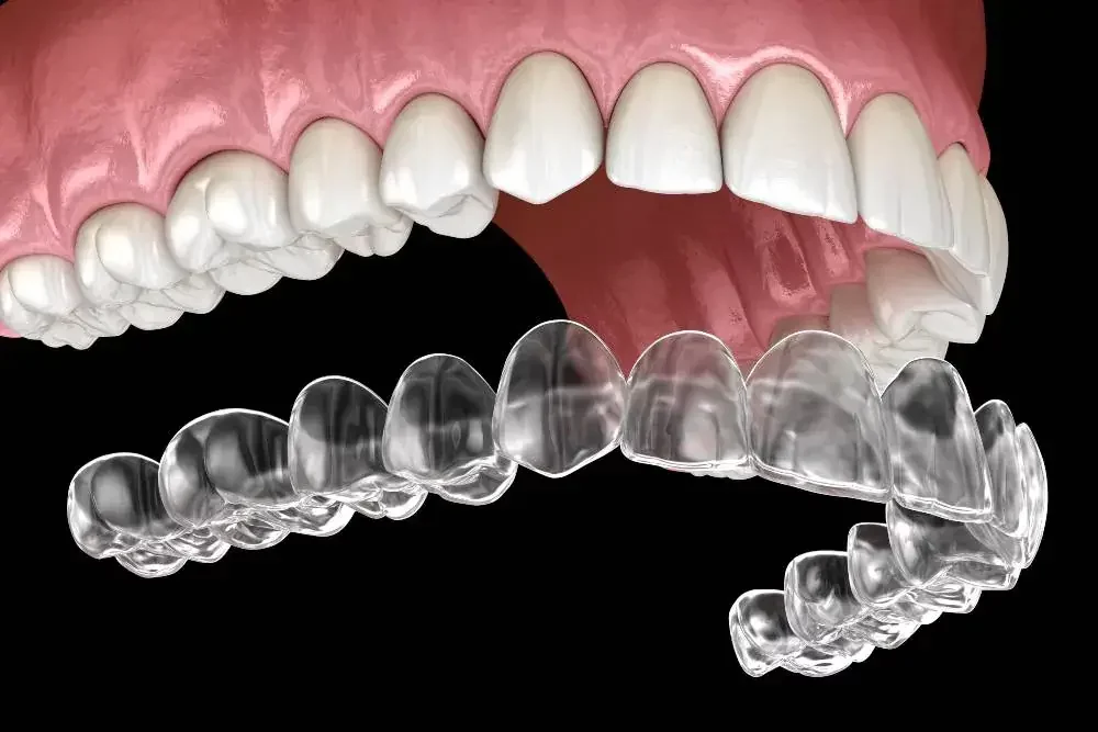 Invisalign Gigi: Pembahasan Lengkap dan Bedanya dengan Behel 5 invisalign gigi 1