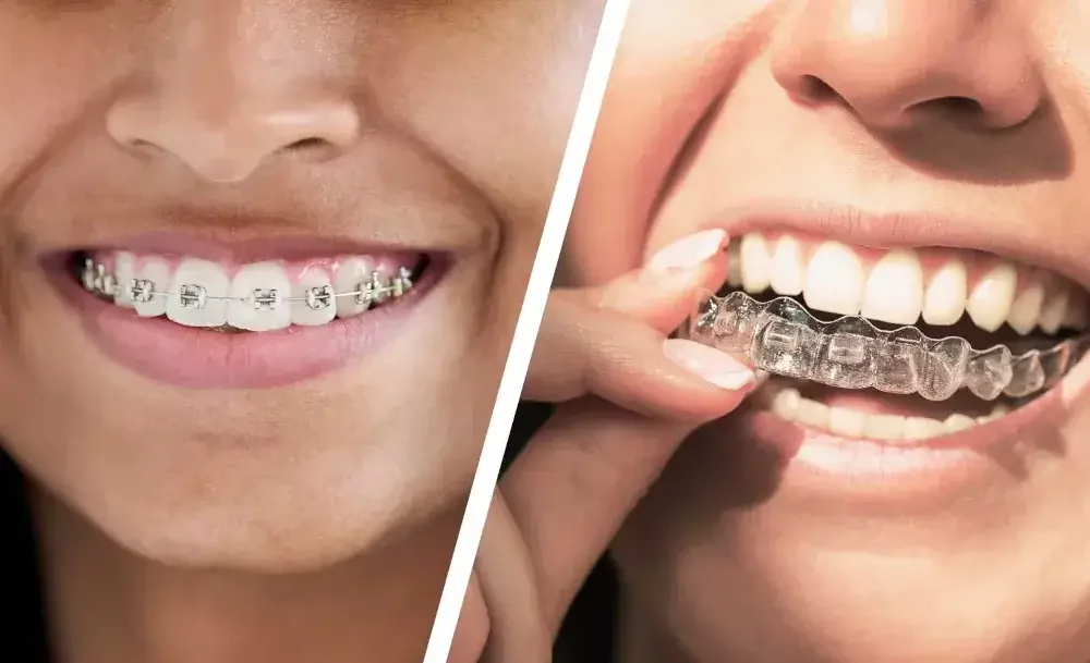Invisalign Gigi: Pembahasan Lengkap dan Bedanya dengan Behel 4 invisalign gigi 3