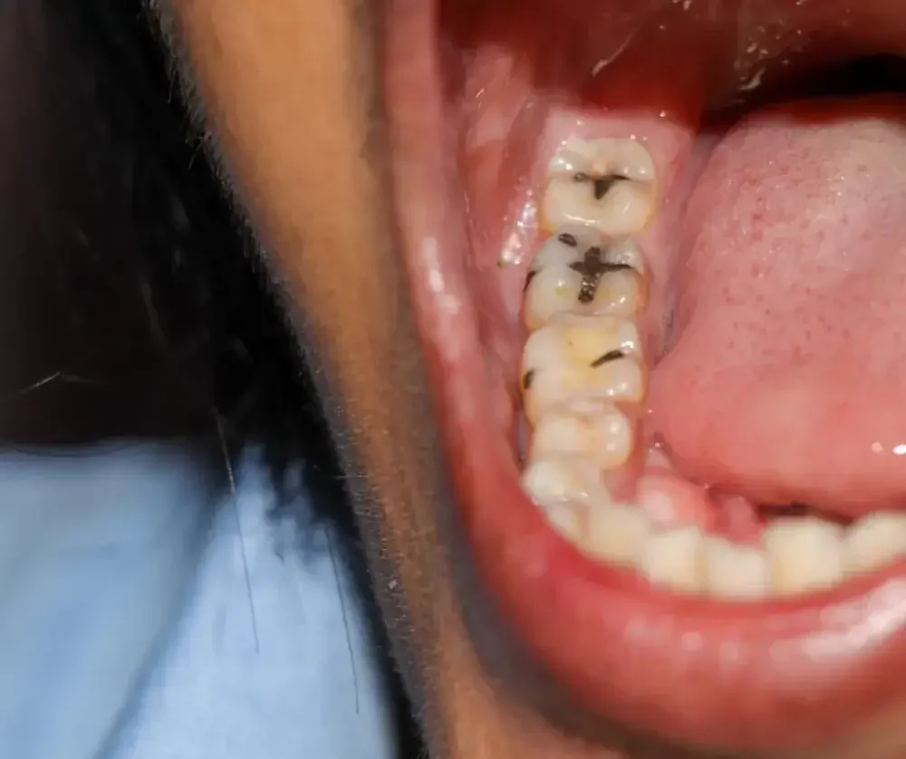 obat sakit gigi berlubang 1