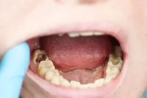 obat sakit gigi berlubang banner