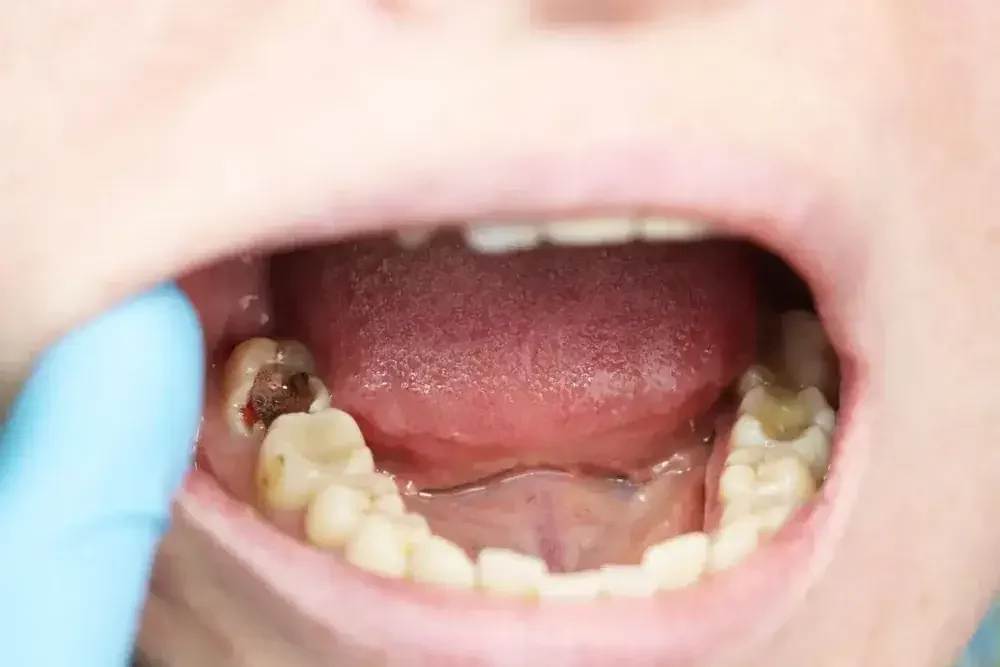 obat sakit gigi berlubang banner