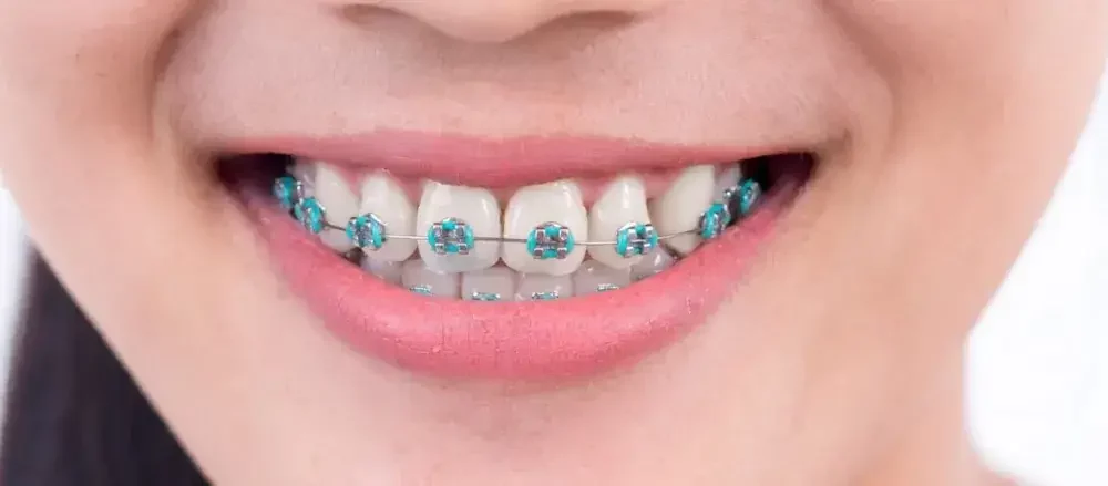 4 Rekomendasi Tempat Pasang Behel Gigi BSD Terbaik 5 pasang behel gigi BSD 1