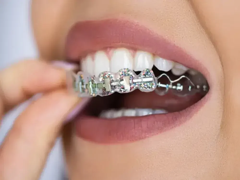 behel fashion dan behel perawatan 2