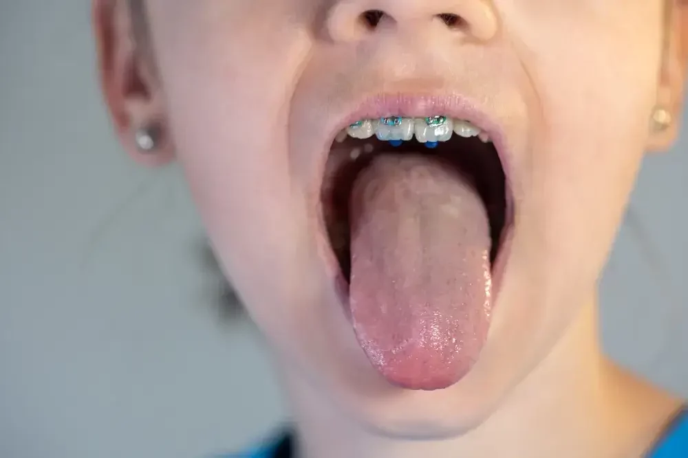 Lidah Berjamur: Gejala, Pengobatan, dan Kapan Harus ke Dokter 2 lidah berjamur 1