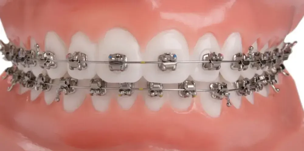 self ligating braces 1