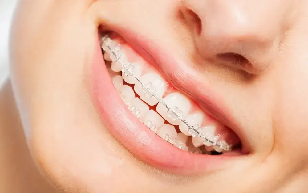 Self Ligating Braces: Kelebihan, Kekurangan, dan Harganya 3 self ligating braces 2