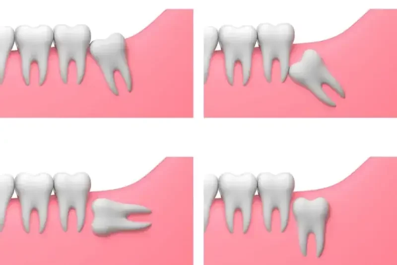 4 Cara agar Gigi Bungsu Tumbuh Normal, Apa Saja? 5 Cara agar Gigi Bungsu Tumbuh Normal 3