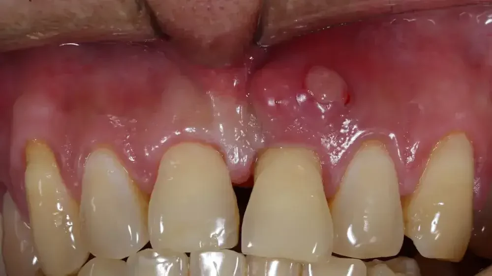 Abses Gusi: Penyebab, Gejala, Diagnosis, dan Pengobatan 2 abses gusi 1