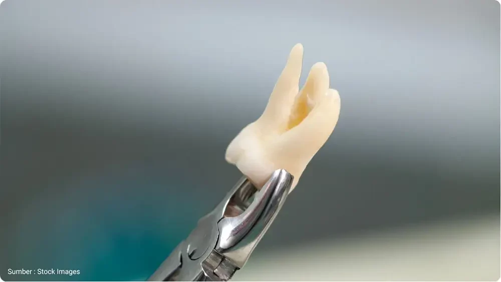 Biaya Cabut Gigi Bungsu: Harga dan Tips Memilih Klinik 3 biaya cabut gigi bungsu 1