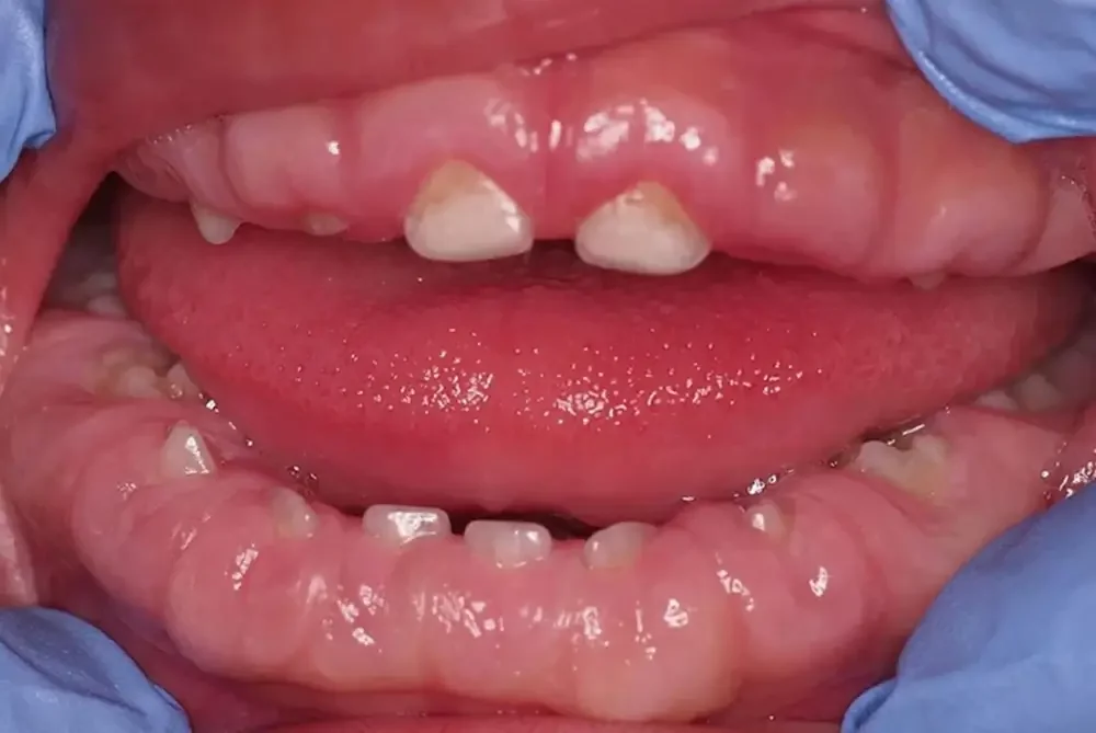 Daging Tumbuh di Gusi: Penyebab, Gejala, dan Pengobatan 3 daging tumbuh di gusi 2