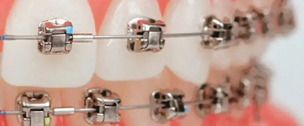 Behel Damon: Perbedaan Dengan Behel Metal dan Kekurangannya 2 behel damon