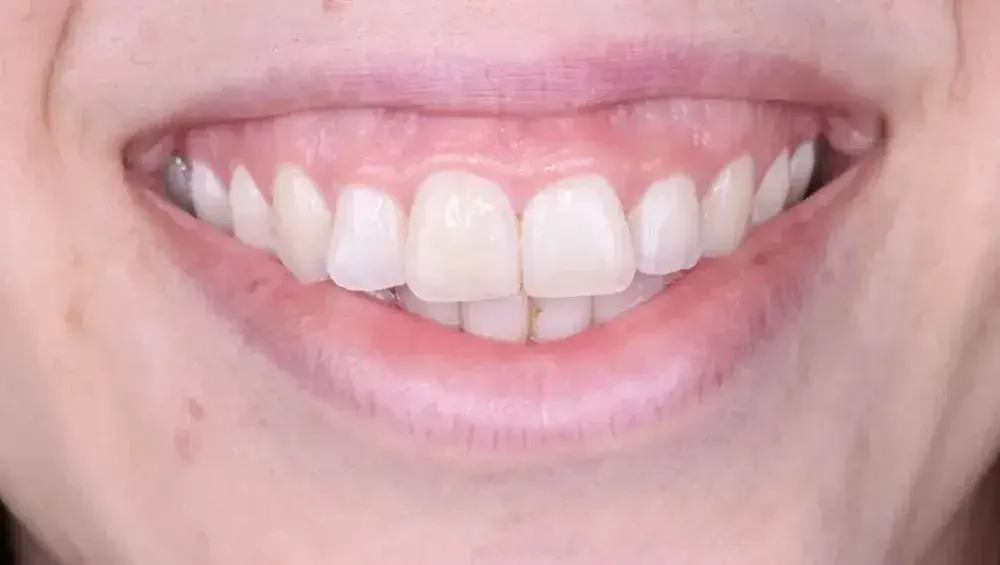 Gummy Smile: Penyebab, Perawatan, dan Pencegahan 2 gummy smile 1