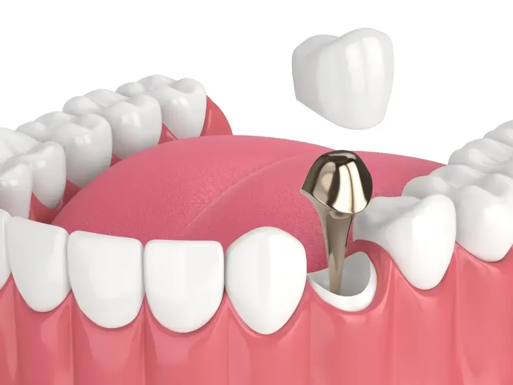 Pasak Gigi: Jenis, Prosedur Pemasangan, dan Manfaatnya 3 pasak gigi 2