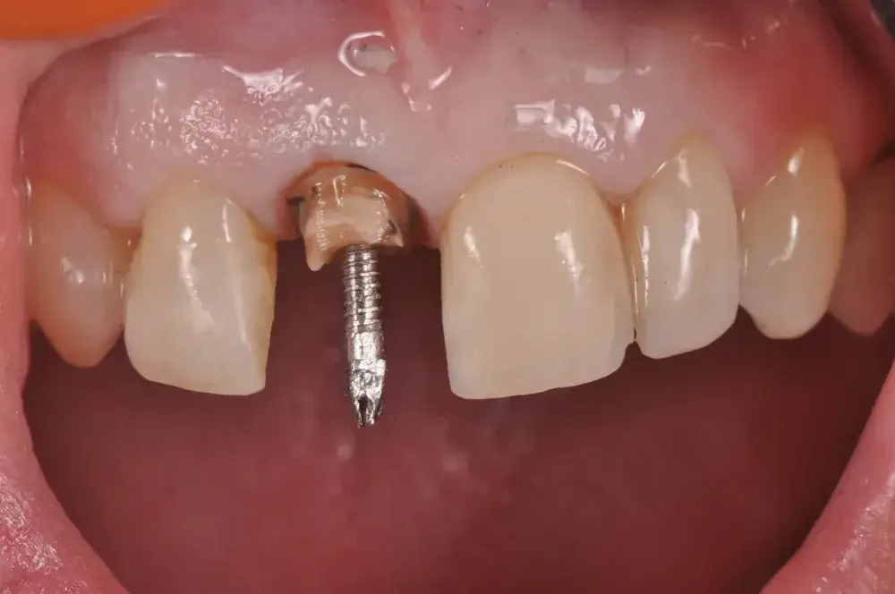 Pasak Gigi: Jenis, Prosedur Pemasangan, dan Manfaatnya 2 pasak gigi 3