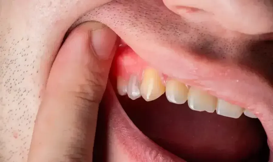 Penyebab Sariawan di Gusi, Gejala, dan Cara Mengatasinya 3 penyebab sariawan di gusi 2