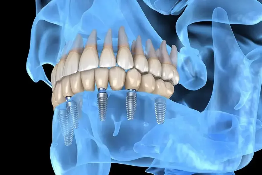 Penyebab Rahang Sakit, Gejala, dan Cara Mengobatinya 4 rahang sakit 2