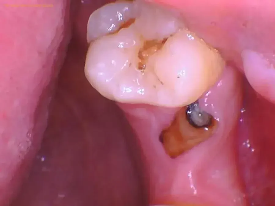 Sisa Akar Gigi Geraham: Penyebab, Gejala, dan Cara Menanganinya 4 sisa akar gigi geraham 2