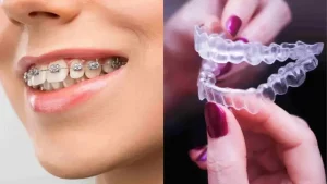 behel dan aligner 1