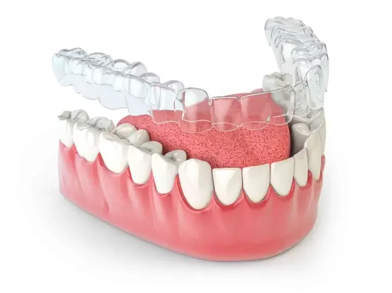 clear aligner terbaik 2