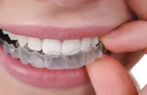 harga clear aligner 1