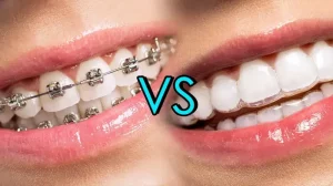 invisalign dan kawat gigi tradisional 1