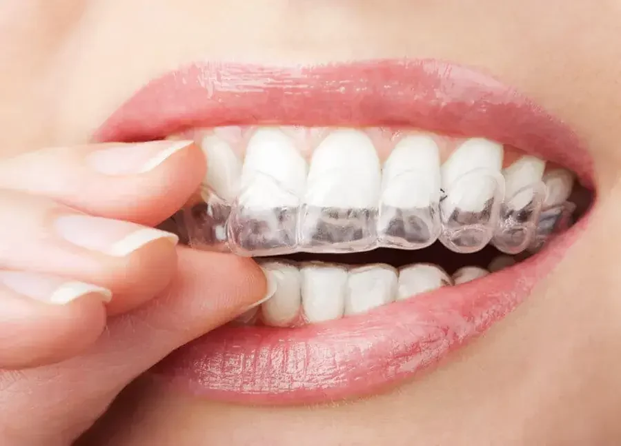 invisalign dan kawat gigi tradisional 2