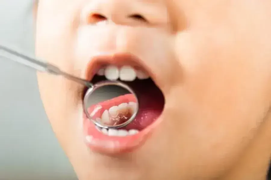 invisalign untuk anak 2