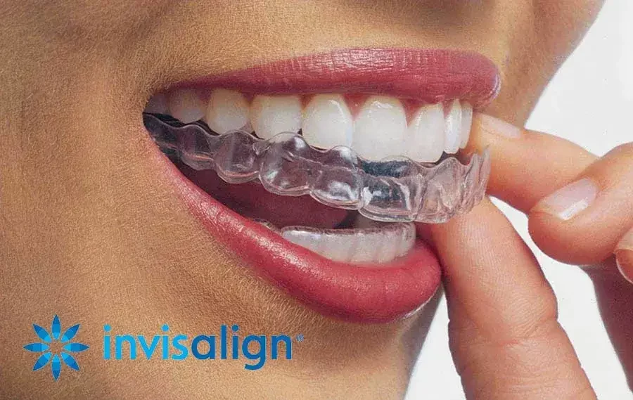 perawatan gigi invisalign 2