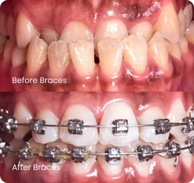 result braces