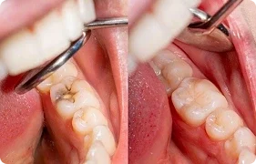 tooth filling