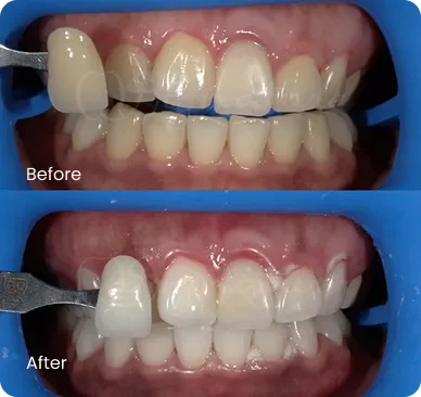 SIGNATURE DENTAL WHITENING 2 1