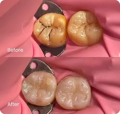 tooth filling 1