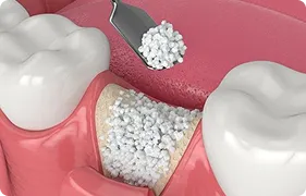 BONE GRAFT
