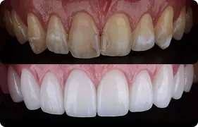 Direct Veneer