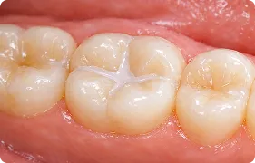 Fissure 1 3