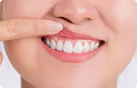 GINGIVOPLASTY 3
