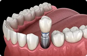 IMPLANT 1