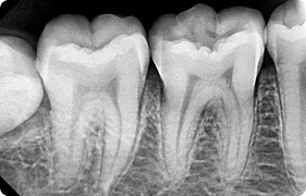 Periapical X Ray 3