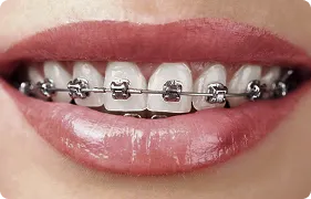 Self Ligating Braces