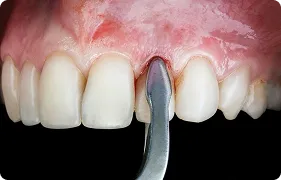 TOOTH EXTRACTION 3