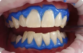 Topical application of fluoride 3