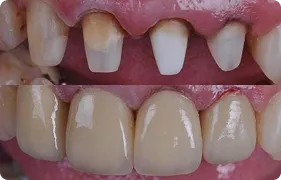 ZIRCONIA