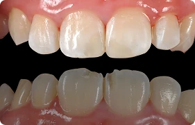 tooth image