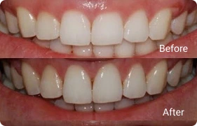 GINGIVECTOMY
